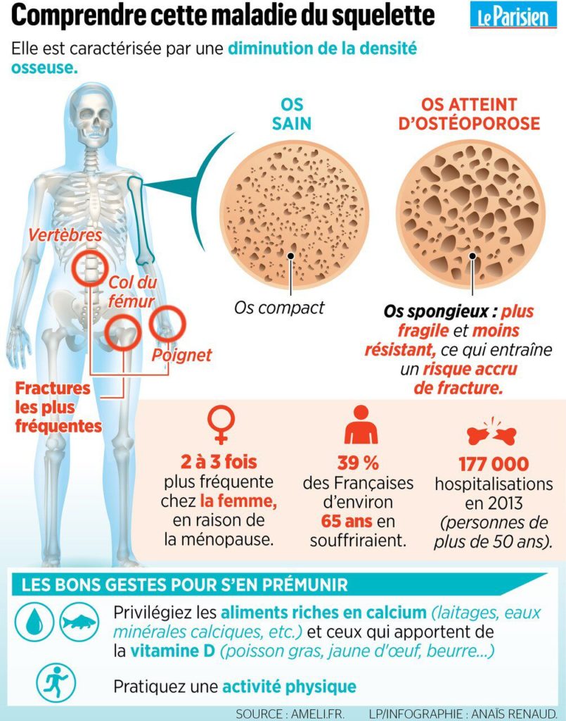 Ostéoporose Infographie Ménopause Leparisien