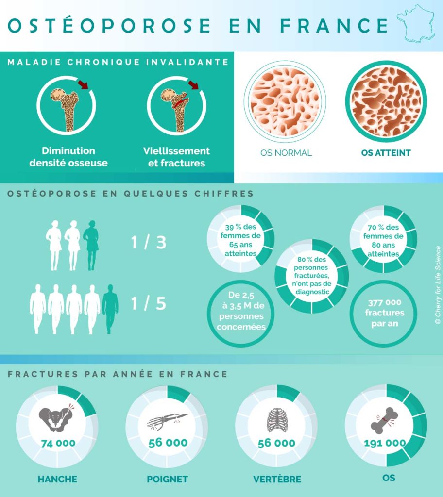 ostéoporose infographie 