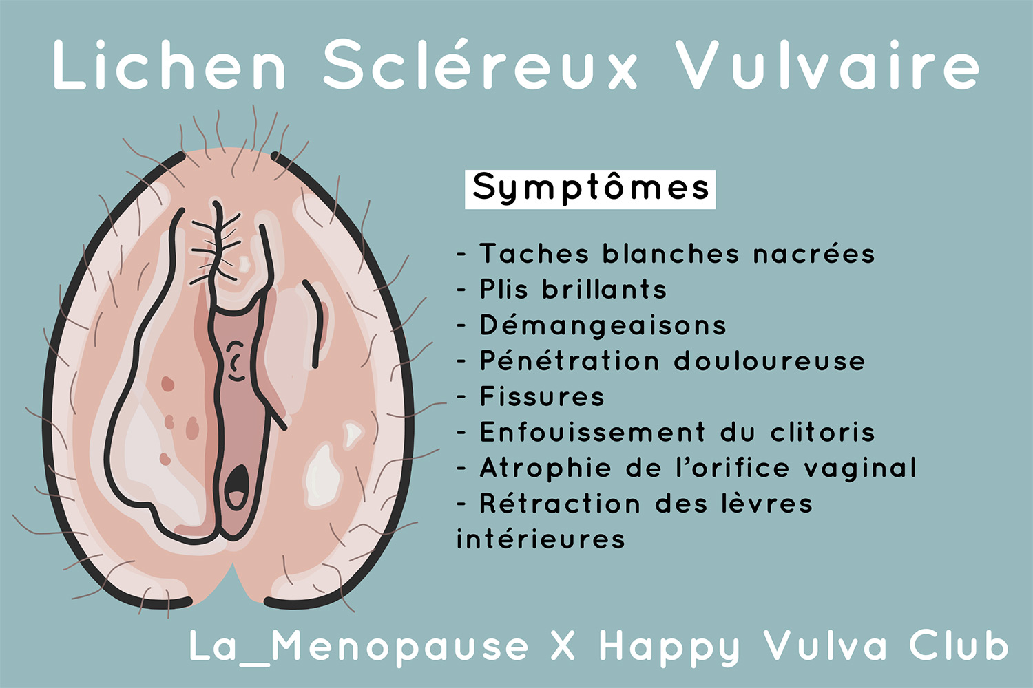 Lichen scléreux vulvaire ou LSV