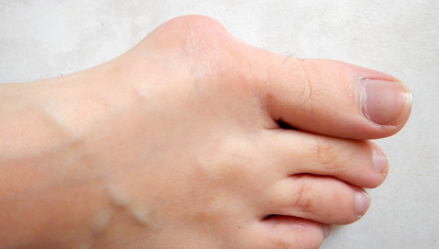 Hallux valgus ou oignon de pied Ménopause information, témoignage, symptômes, traitement