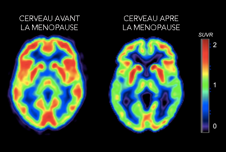 cerveau avant et après la ménopause