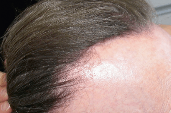 alopecie frontale fibrosante à la ménopause